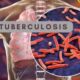 Nigerians Test Positive For TB