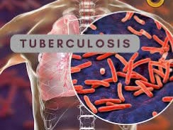 Nigerians Test Positive For TB