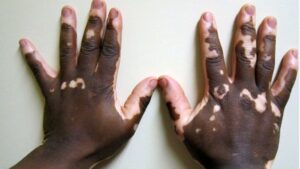 Vitiligo Treatable