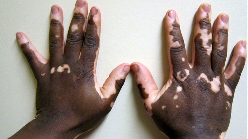 Vitiligo Treatable
